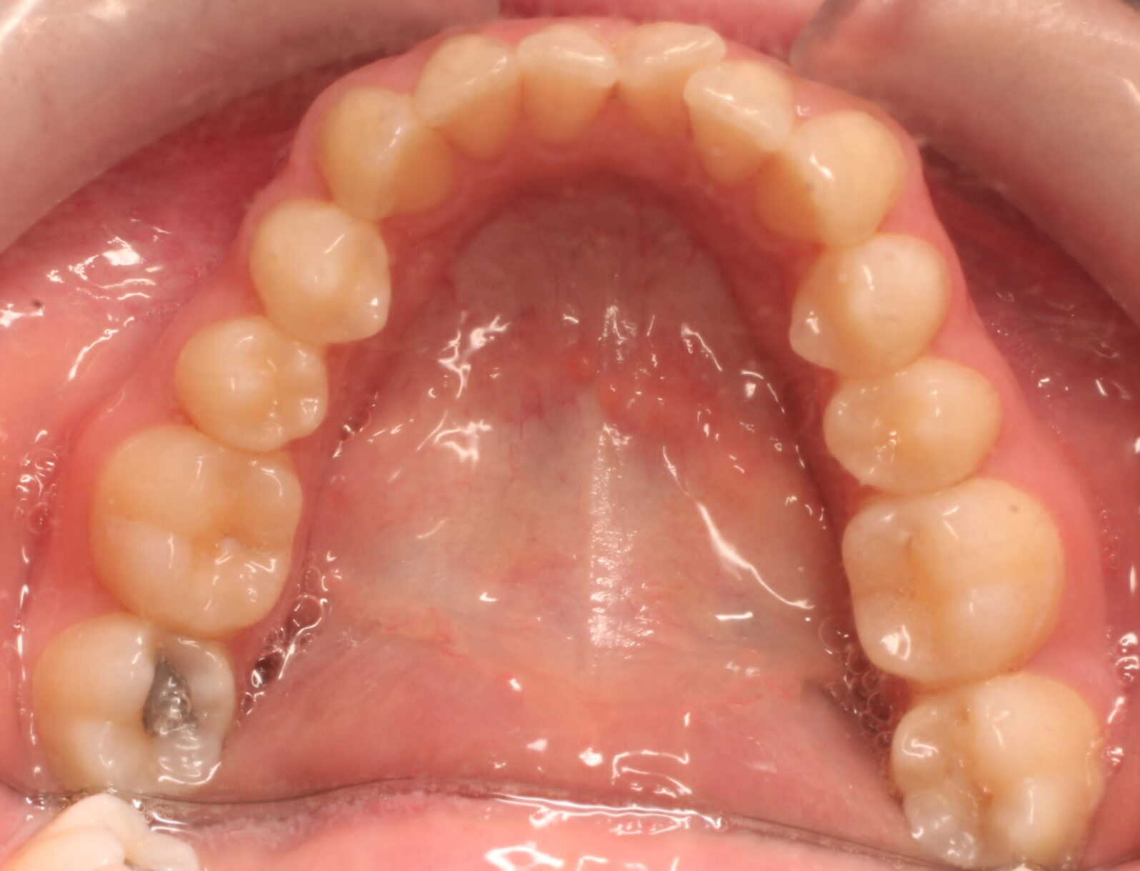 Before braces lower teeth