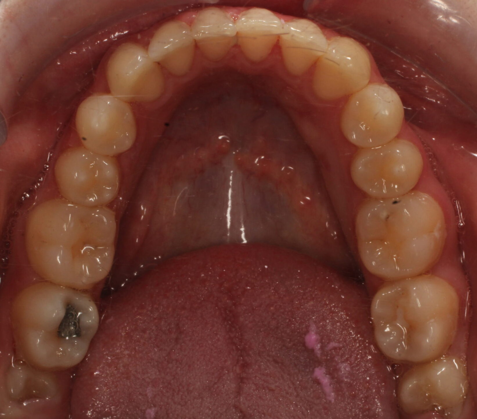 After braces lower teeth