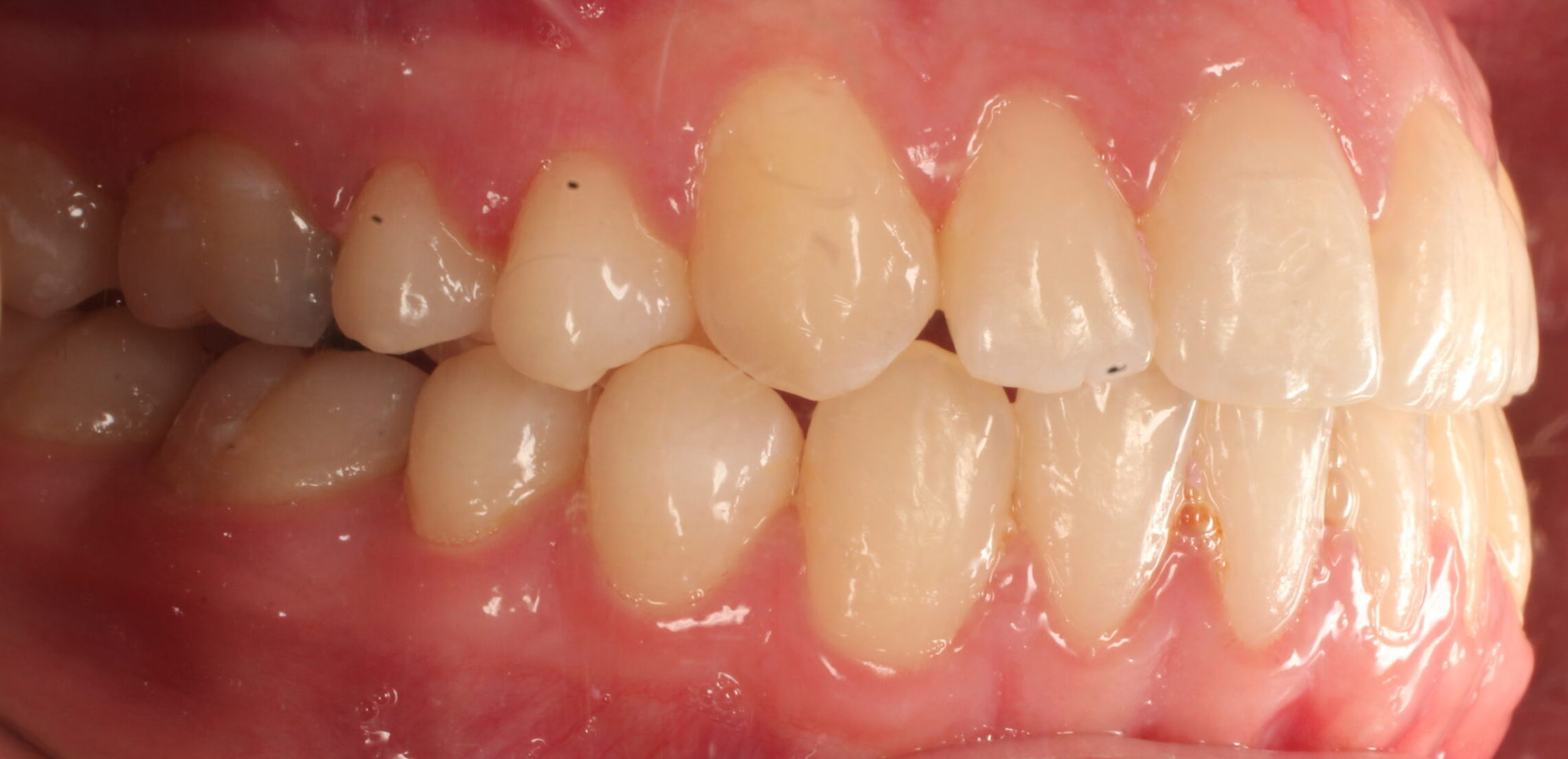 After braces right teeth