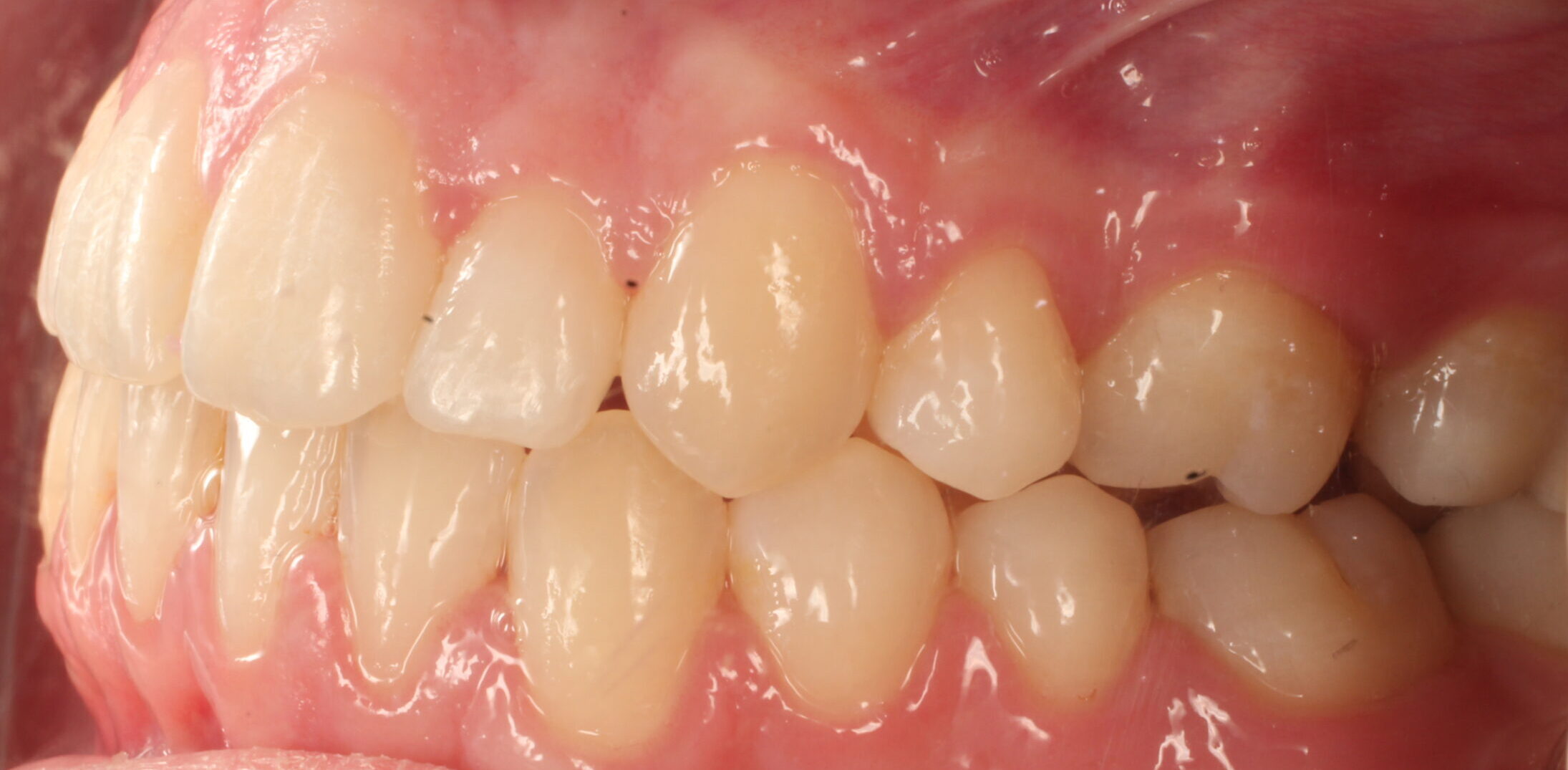 After braces left teeth