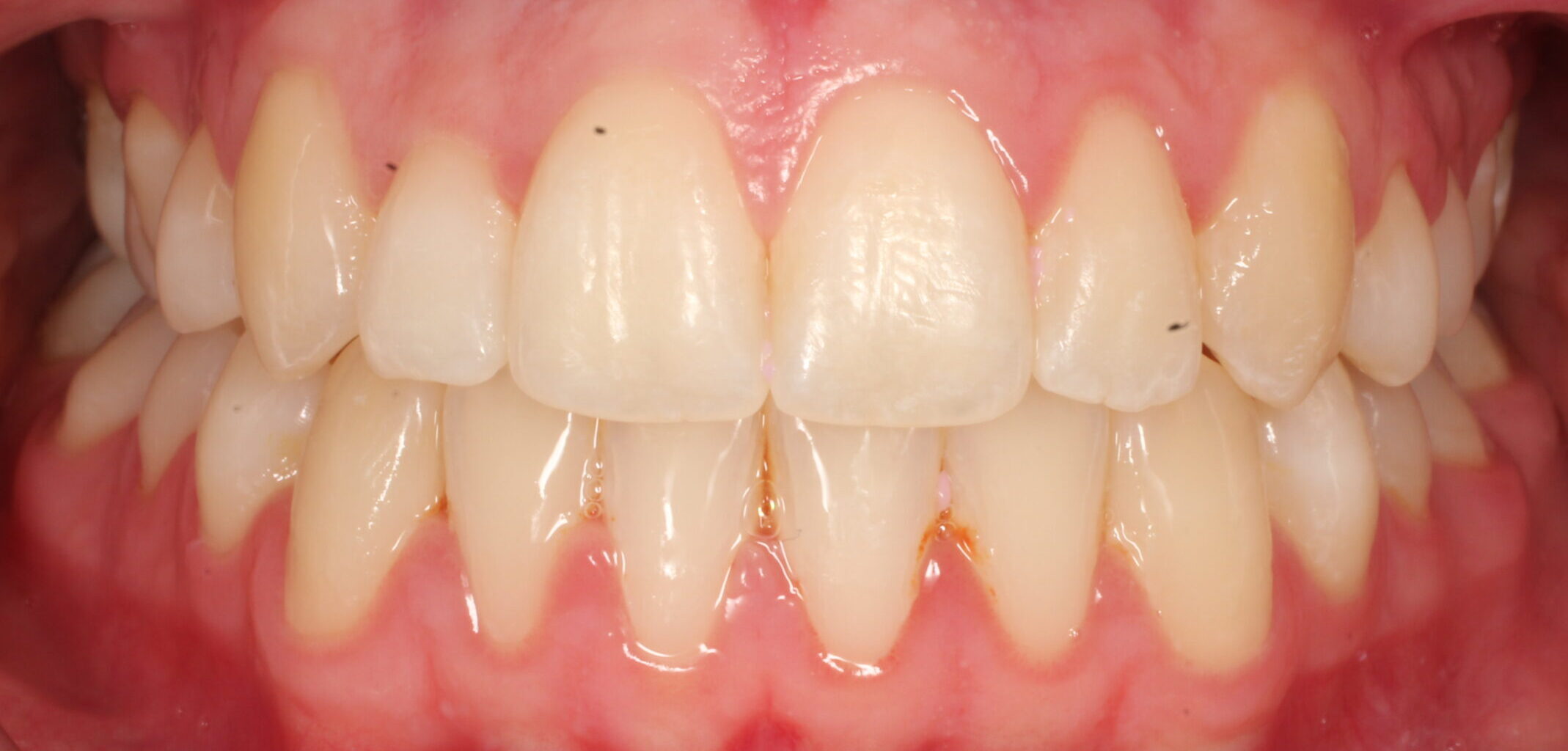 After braces front teeth