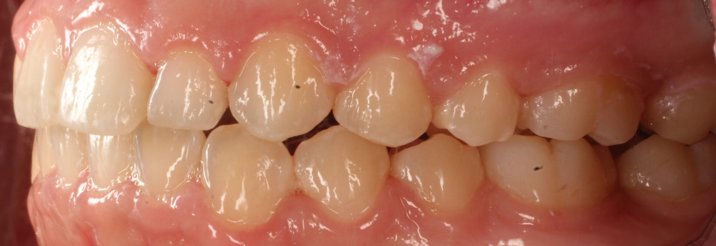 After braces left teeth