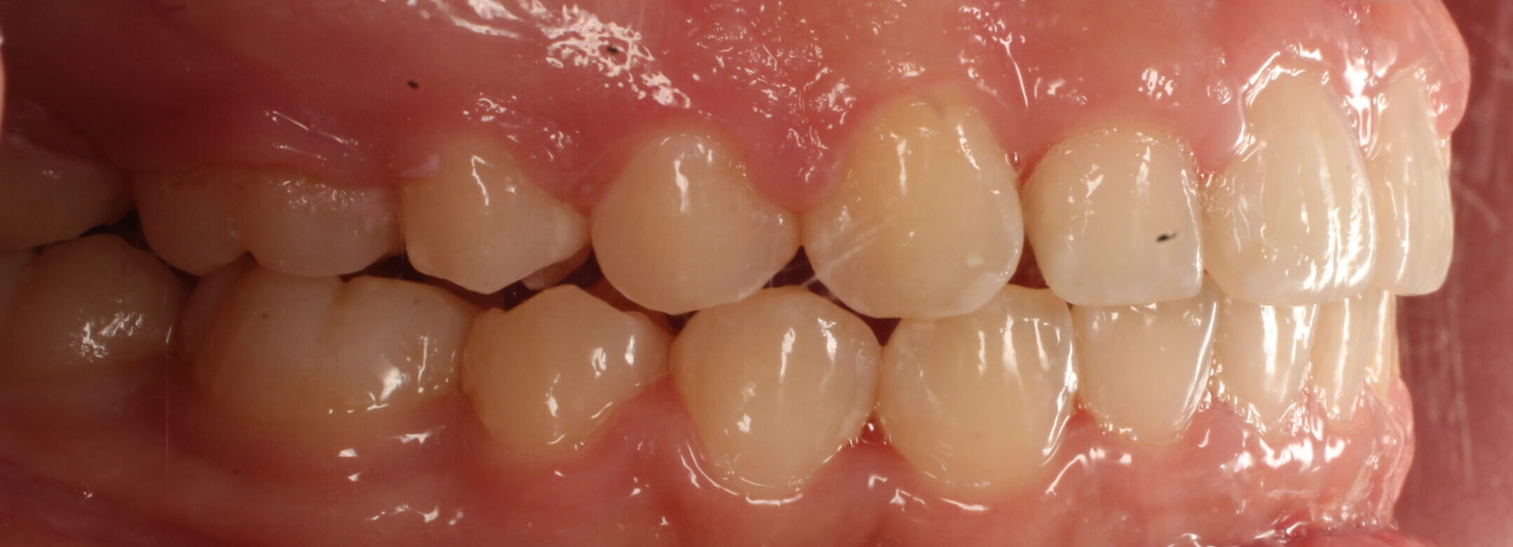 After braces right teeth