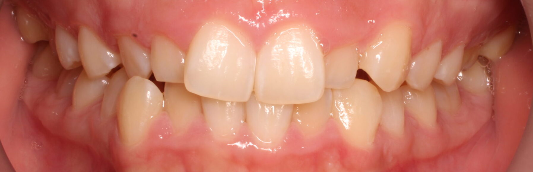 Before braces front teeth
