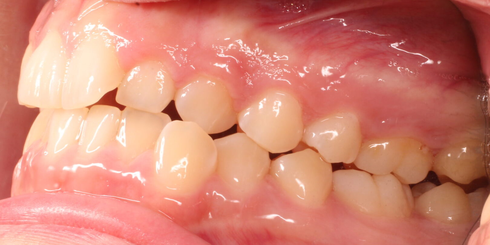 Before braces left teeth