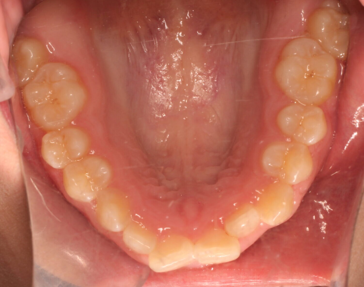 Before braces upper teeth