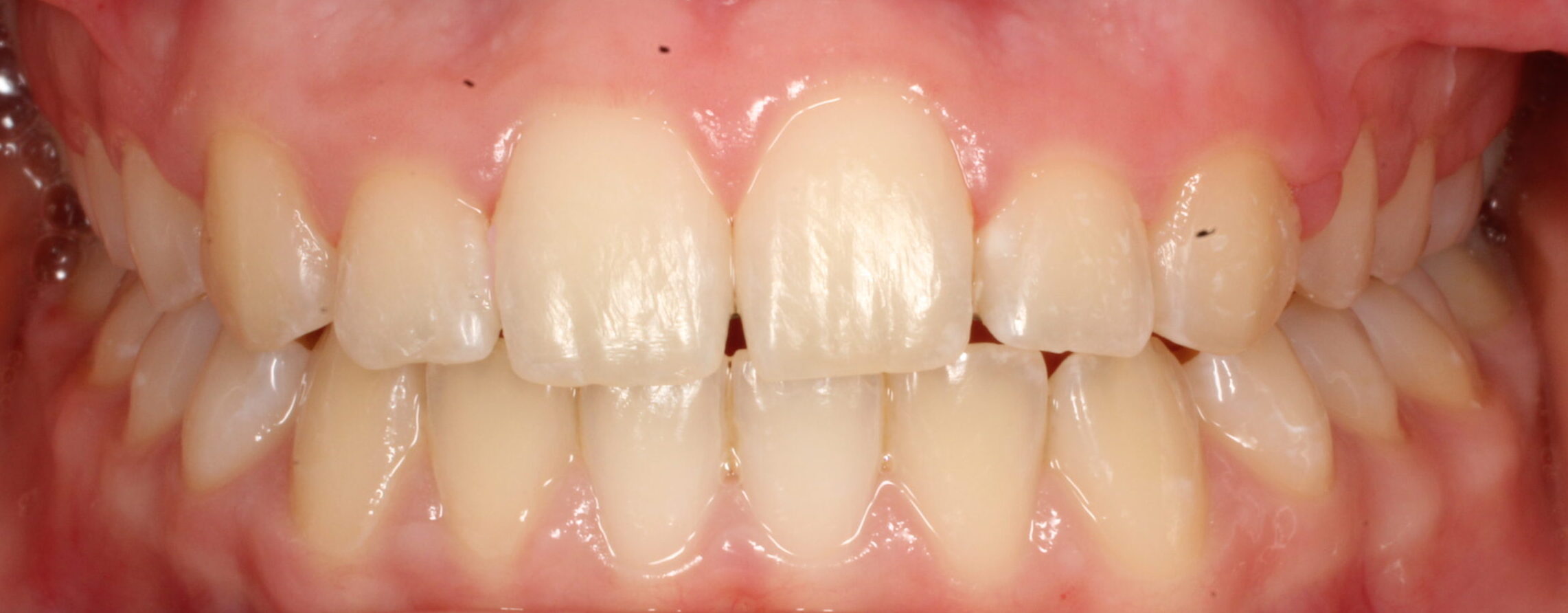 After braces front teeth