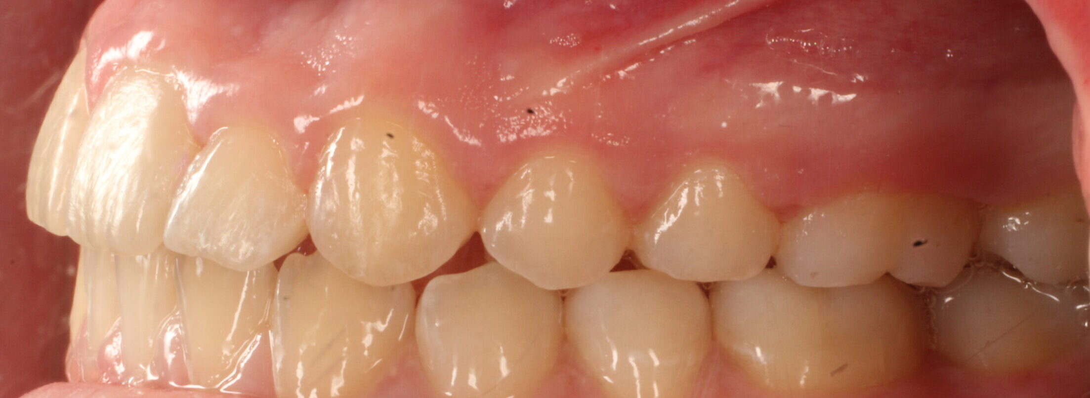 After braces left teeth