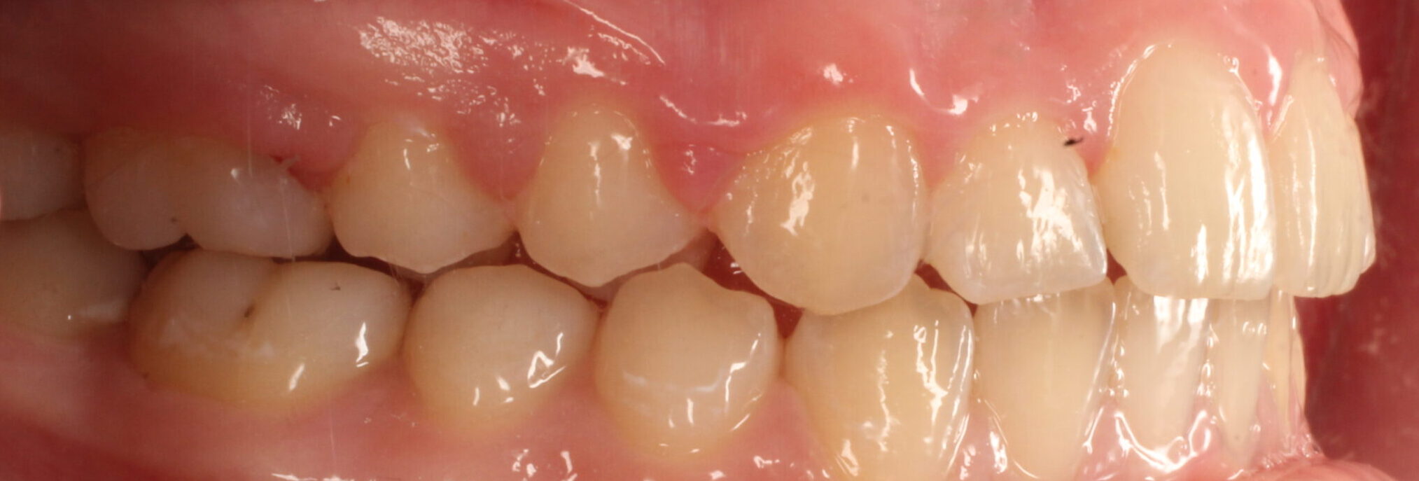 After braces right teeth