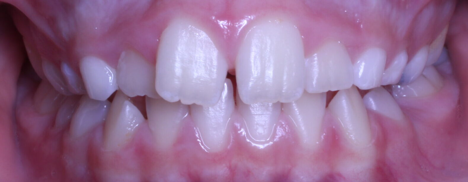 Before braces front teeth