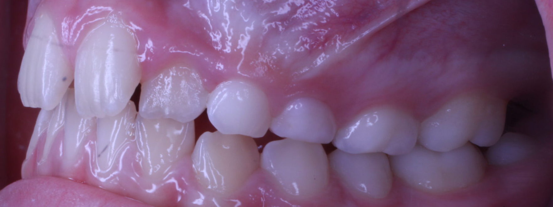 Before braces left teeth