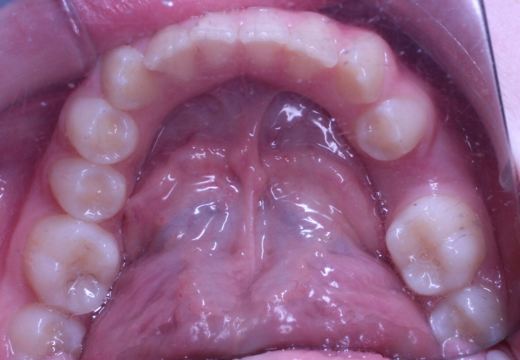 Before braces lower teeth