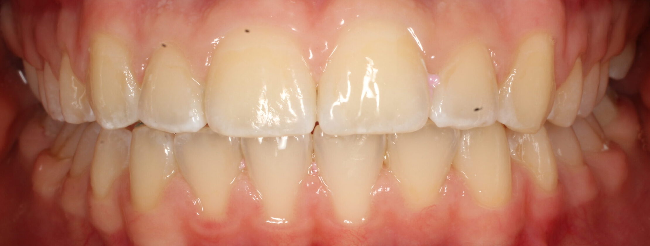 After braces front teeth