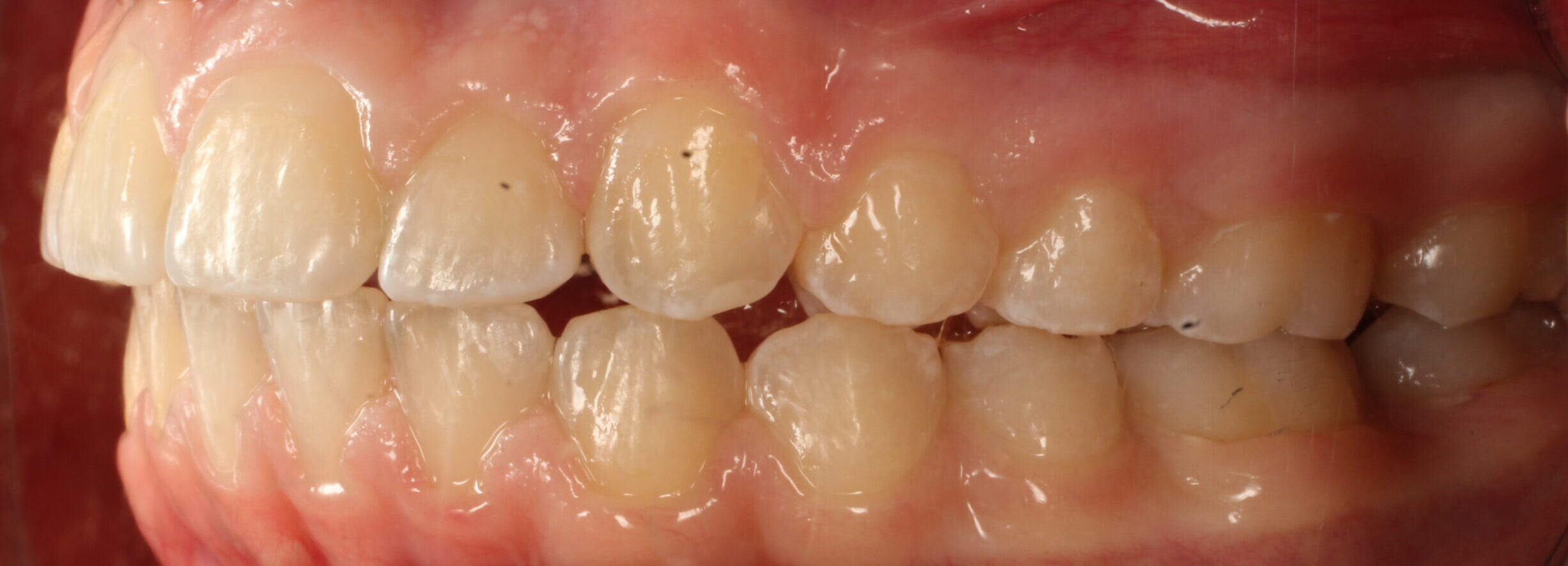 After braces left teeth