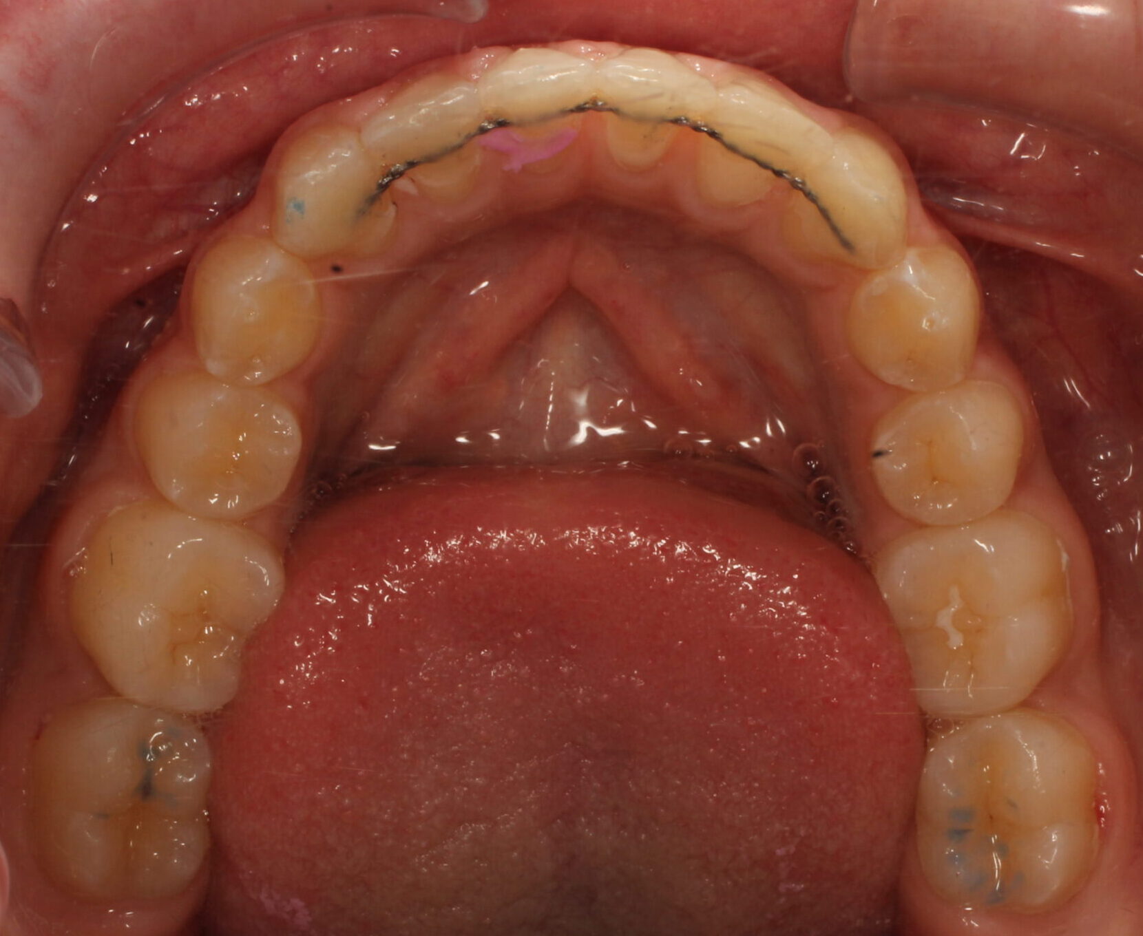 After braces lower teeth