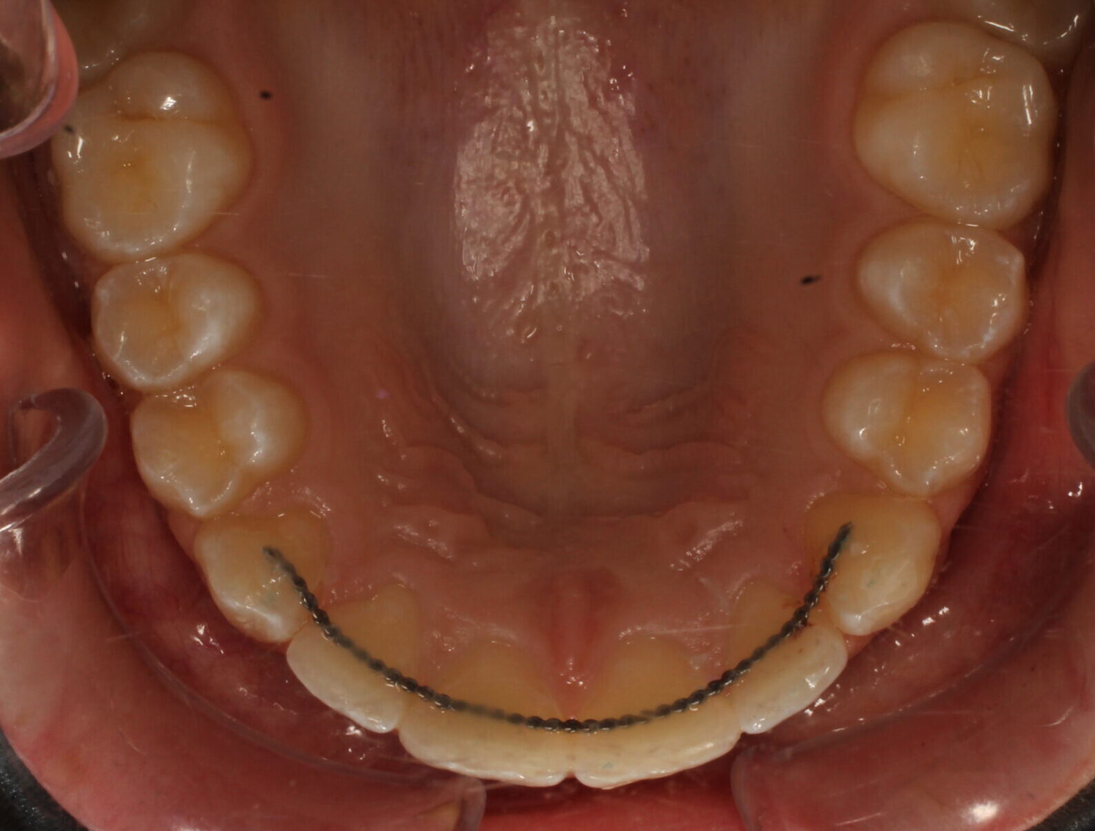 After braces upper teeth