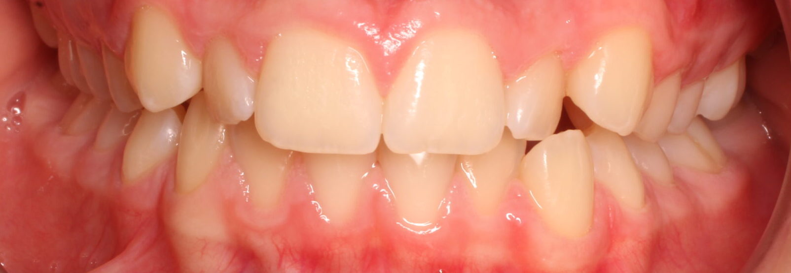 Before braces front teeth