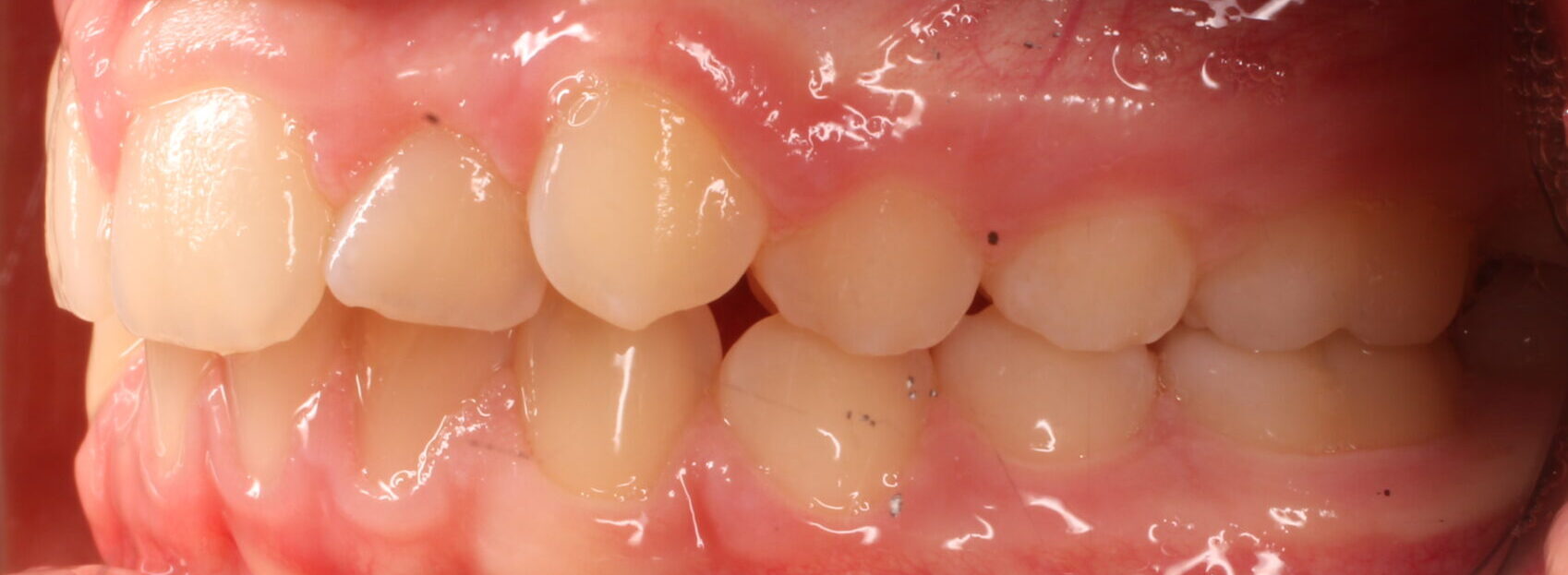 Before braces left teeth