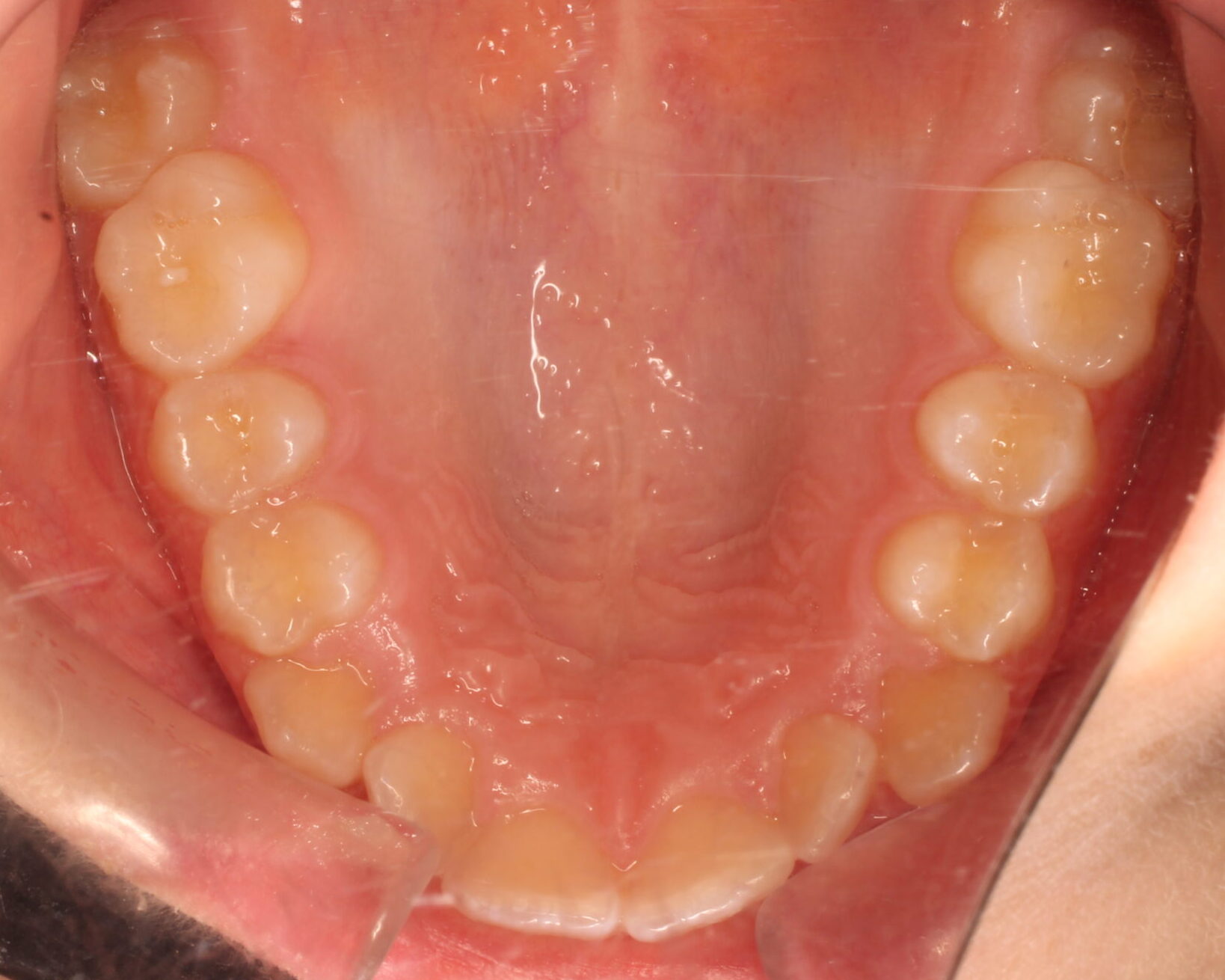 Before braces upper teeth