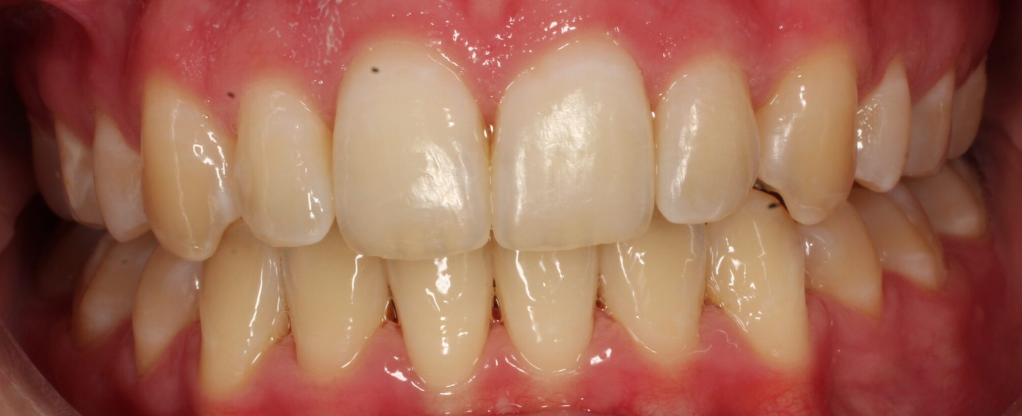 After braces front teeth