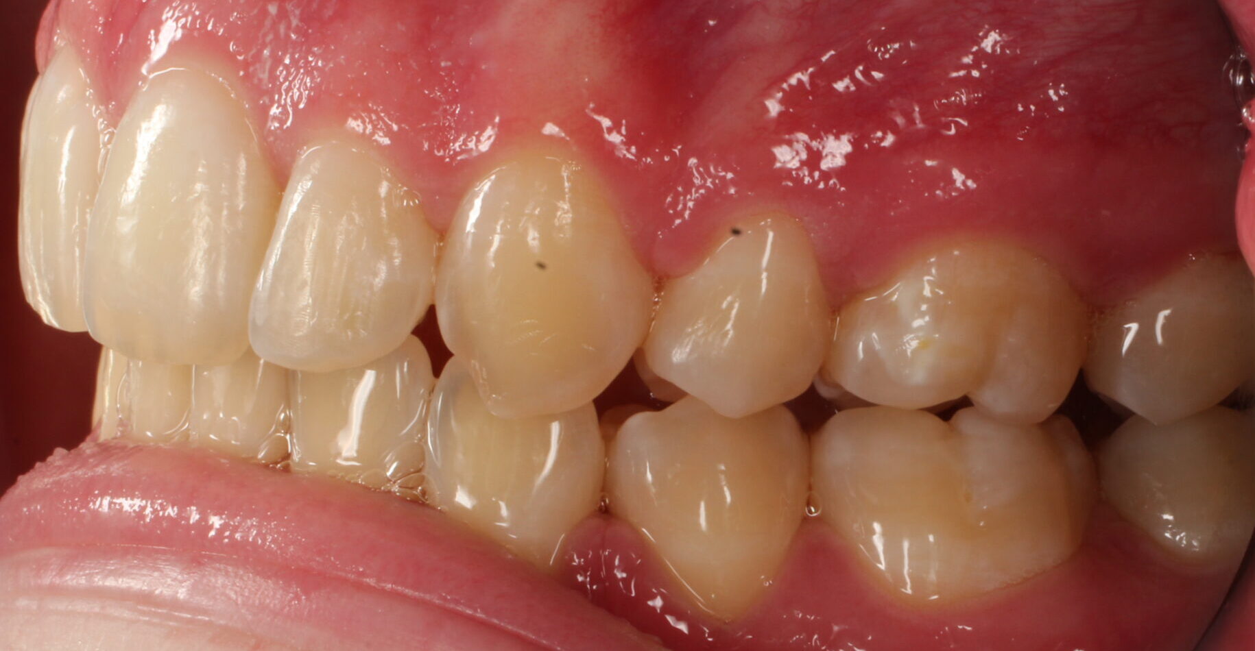 After braces left teeth