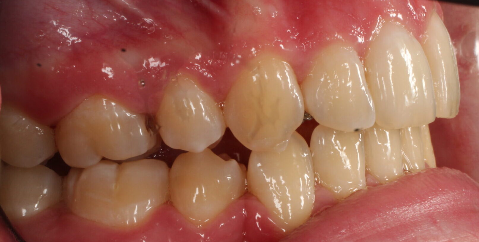 After braces right teeth