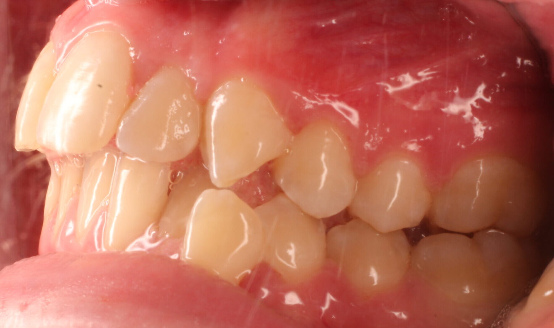 Before braces left teeth