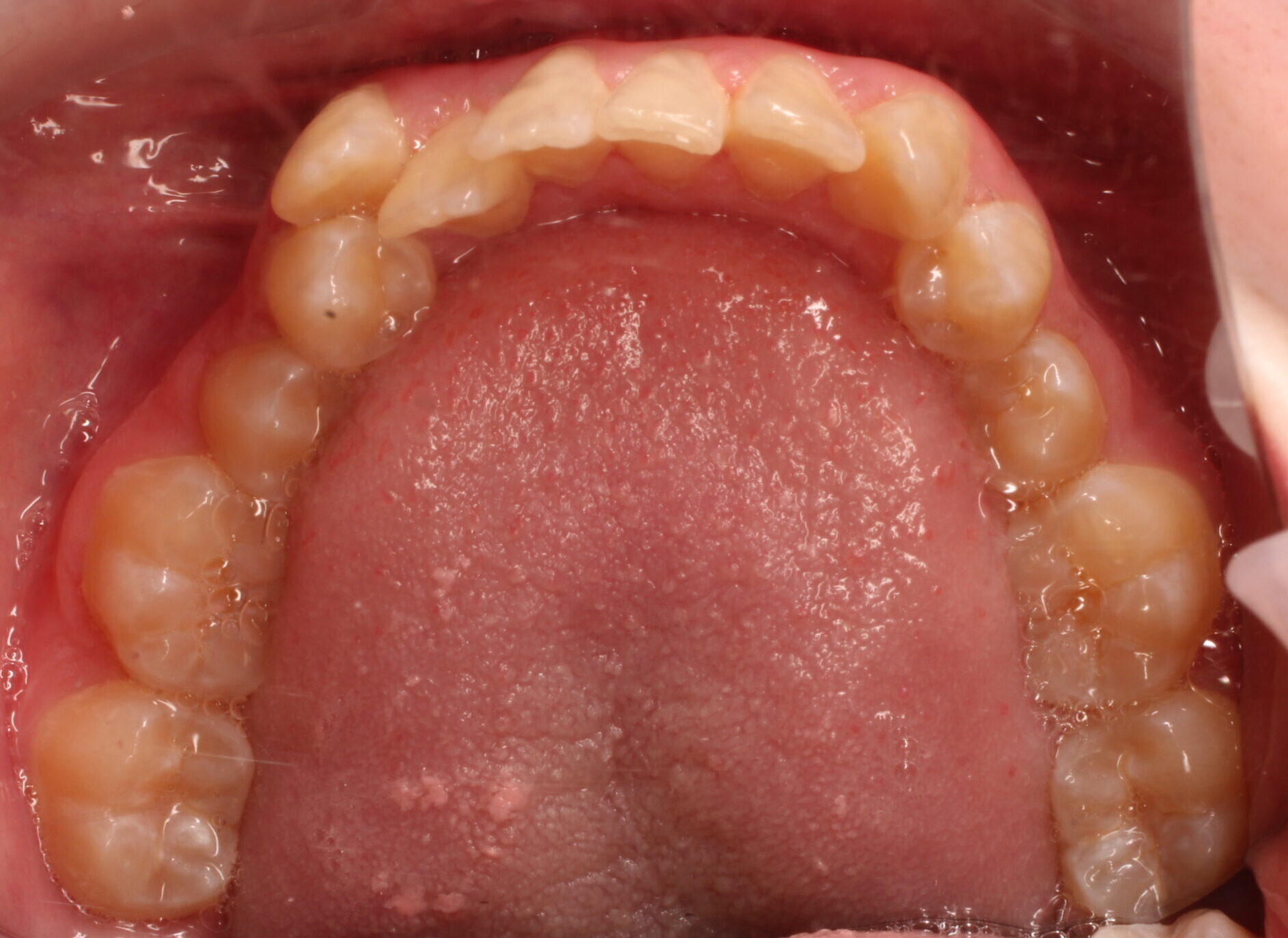 Before braces lower teeth