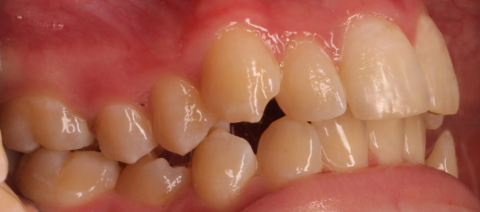 Before braces right teeth