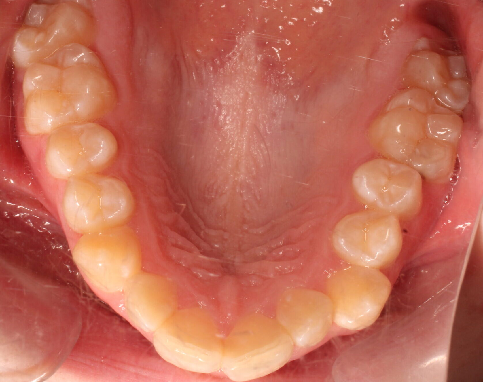 Before braces upper teeth