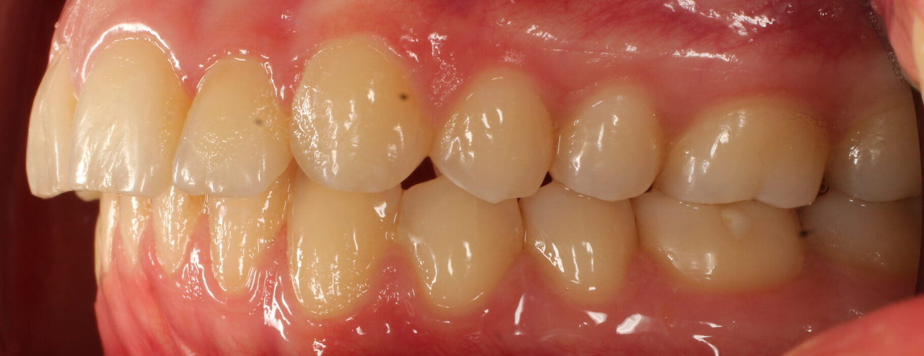 After braces left teeth