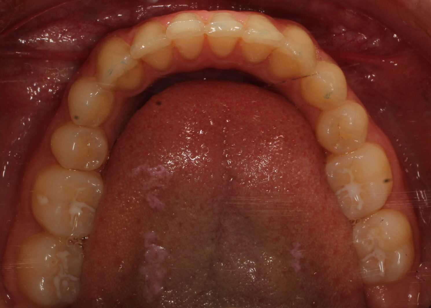 After braces lower teeth