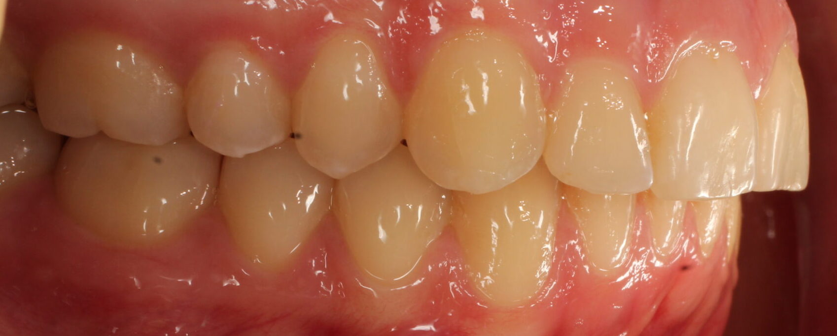 After braces right teeth