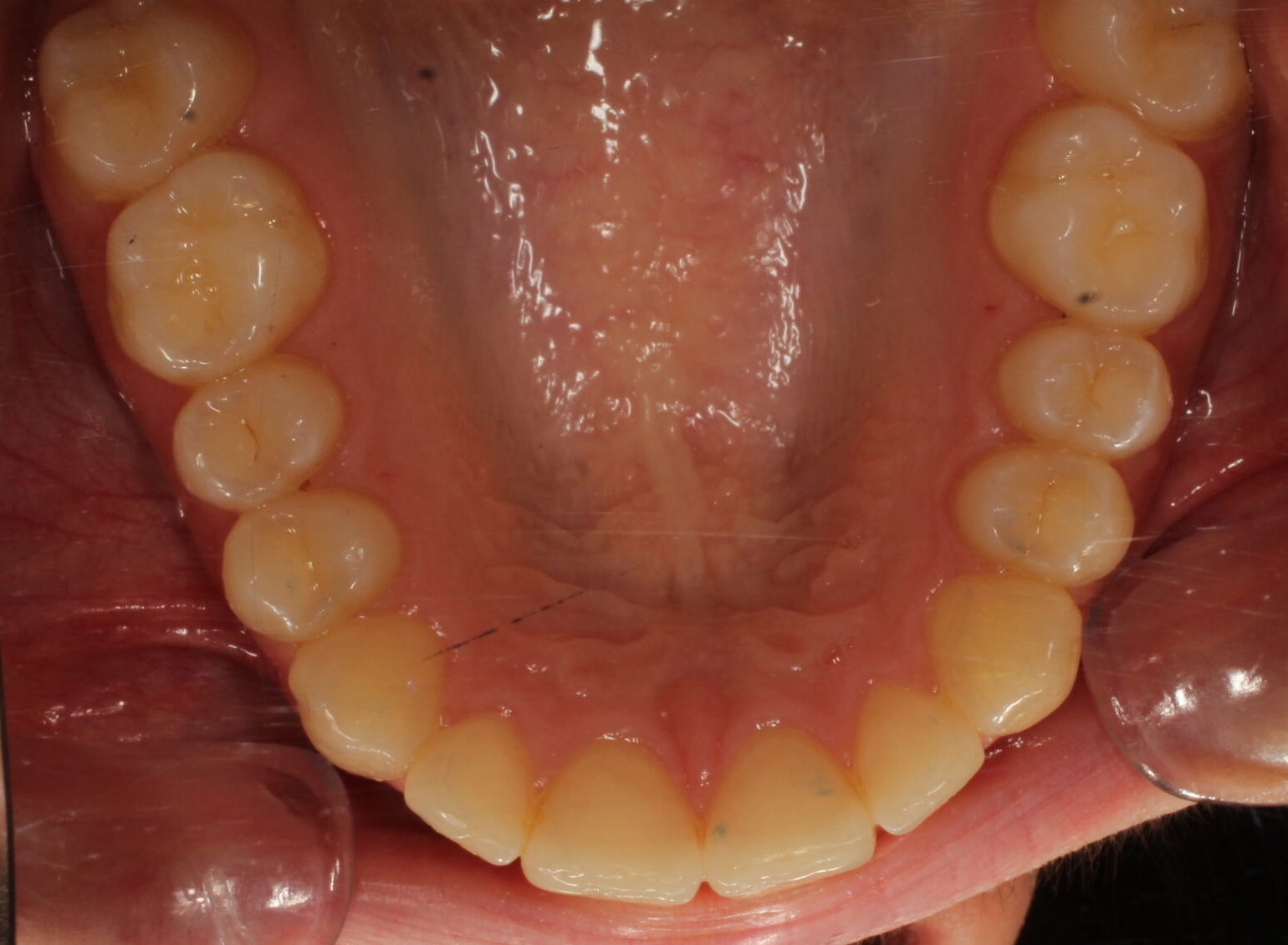 After braces upper teeth