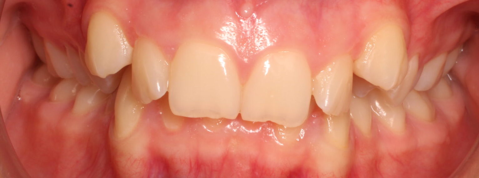 Before braces front teeth