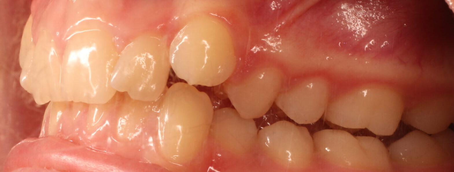 Before braces left teeth