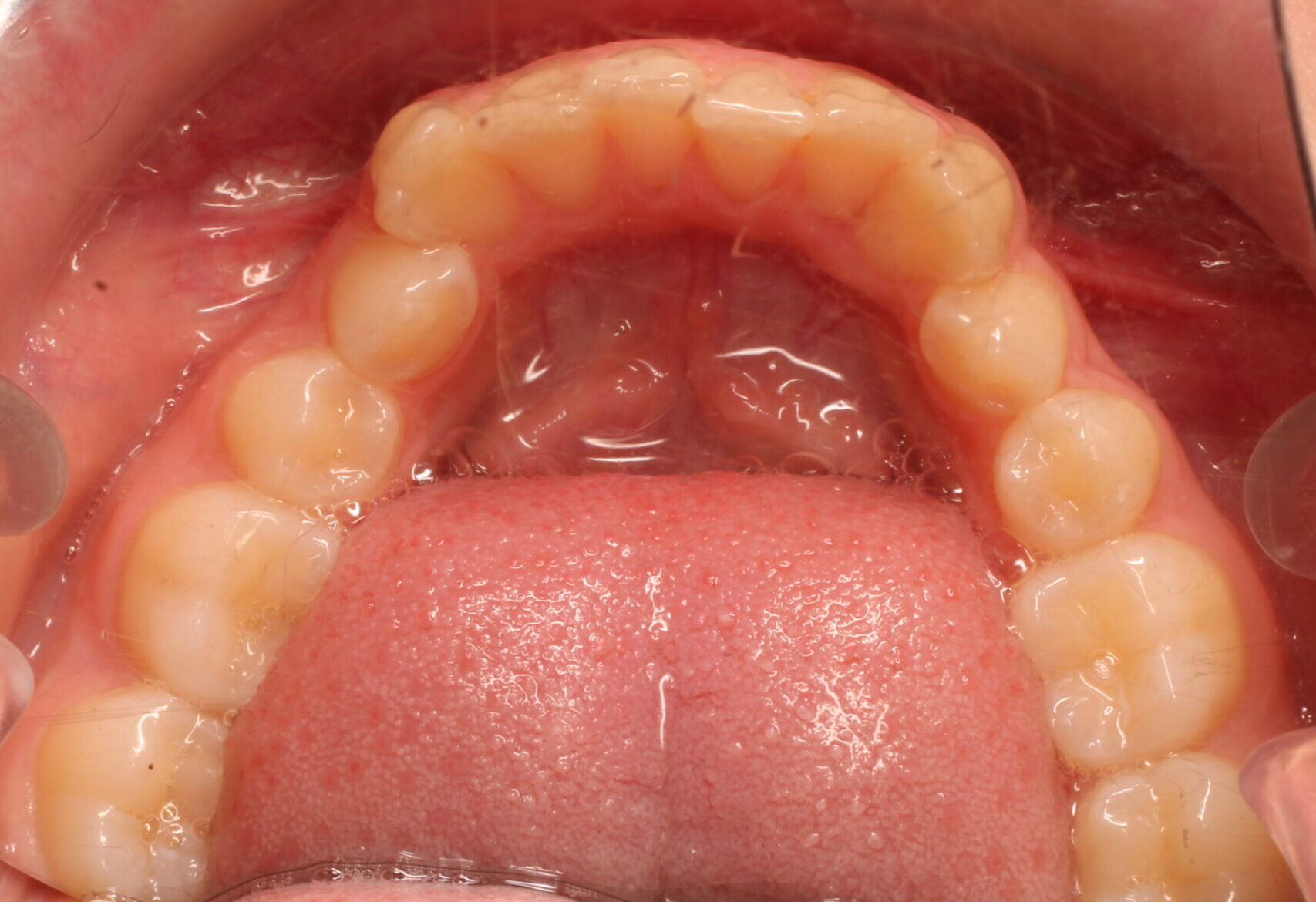 Before braces lower teeth