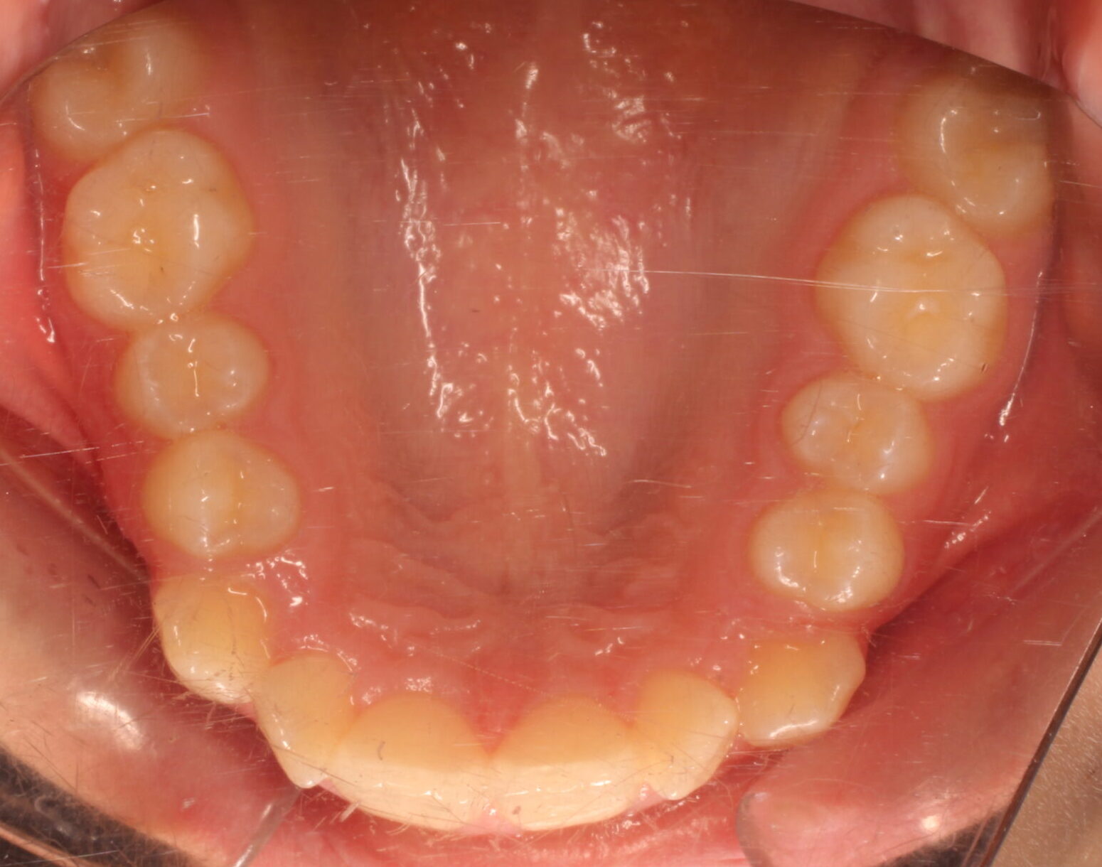 Before braces upper teeth