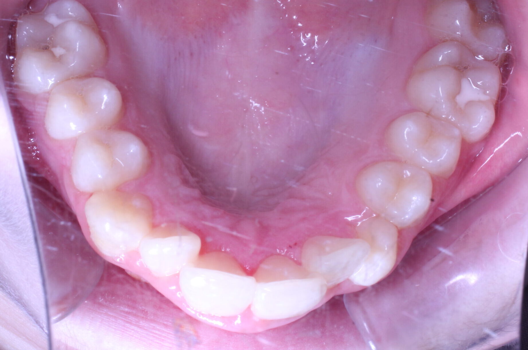 Before braces upper teeth