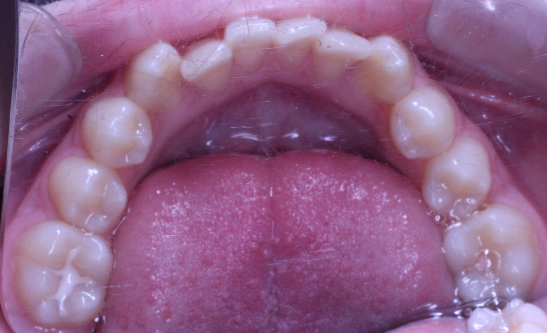 Before braces lower teeth