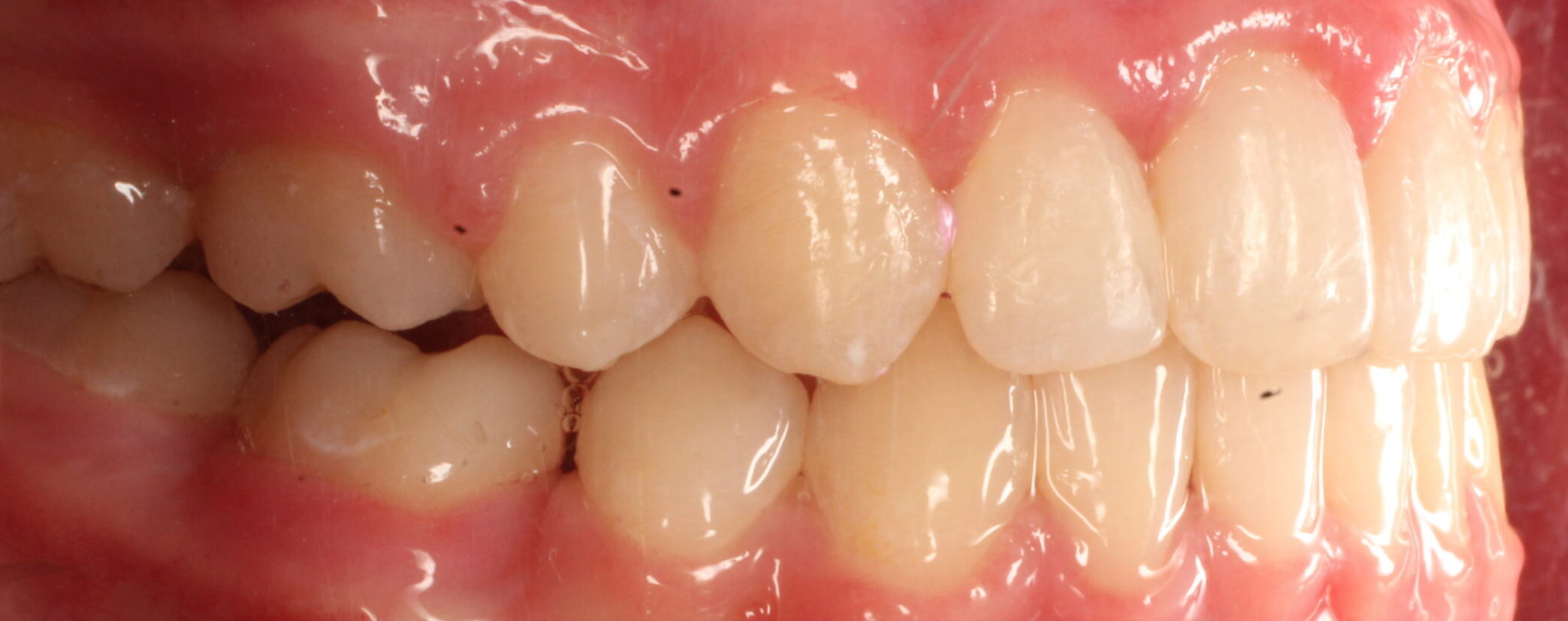 After braces right teeth