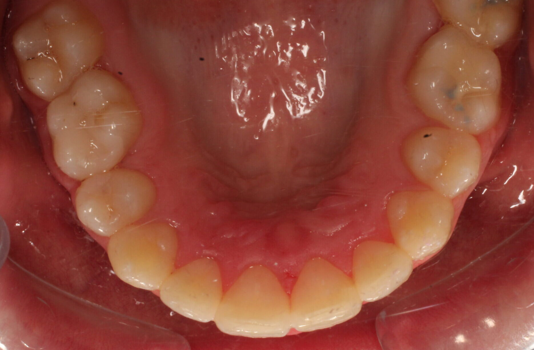 After braces upper teeth