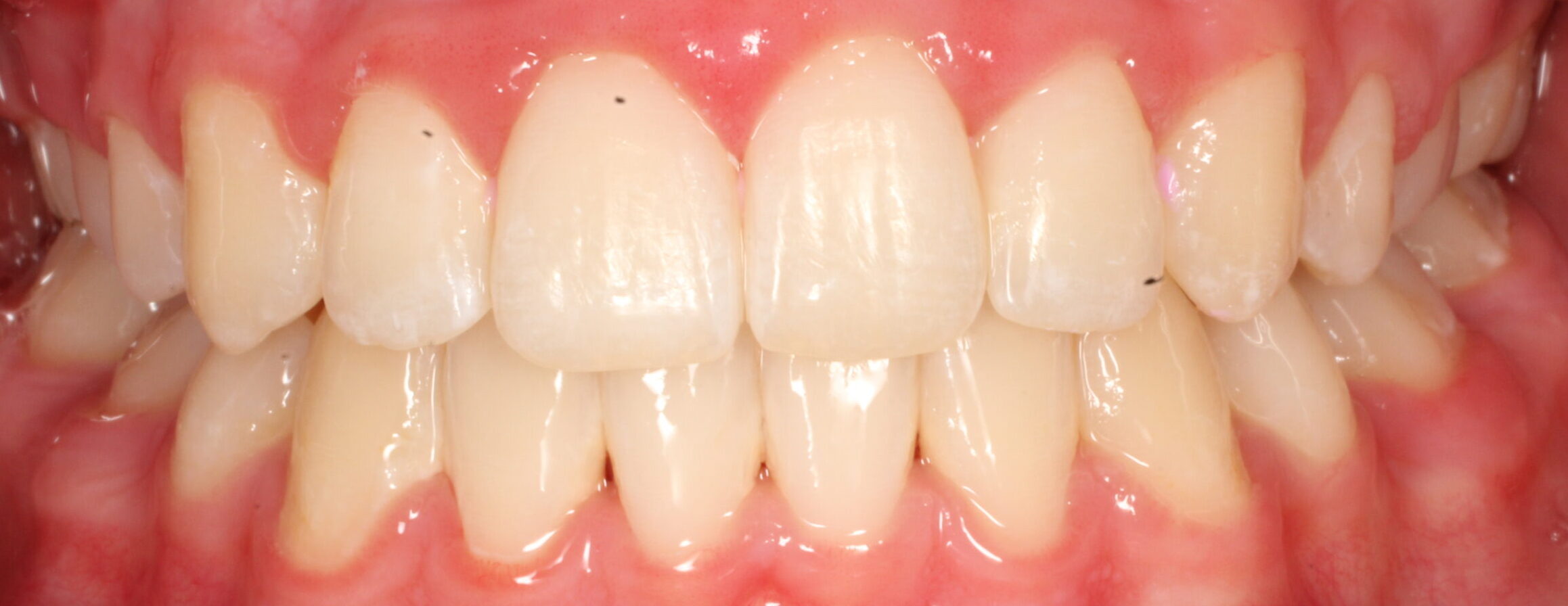 After braces front teeth