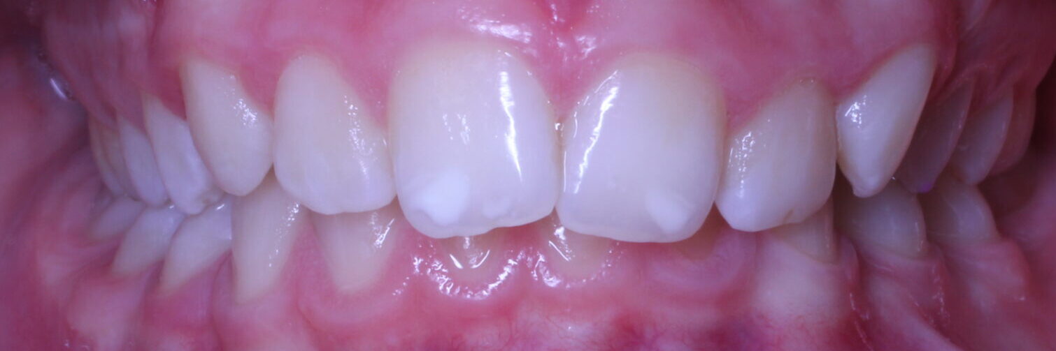 Before braces front teeth