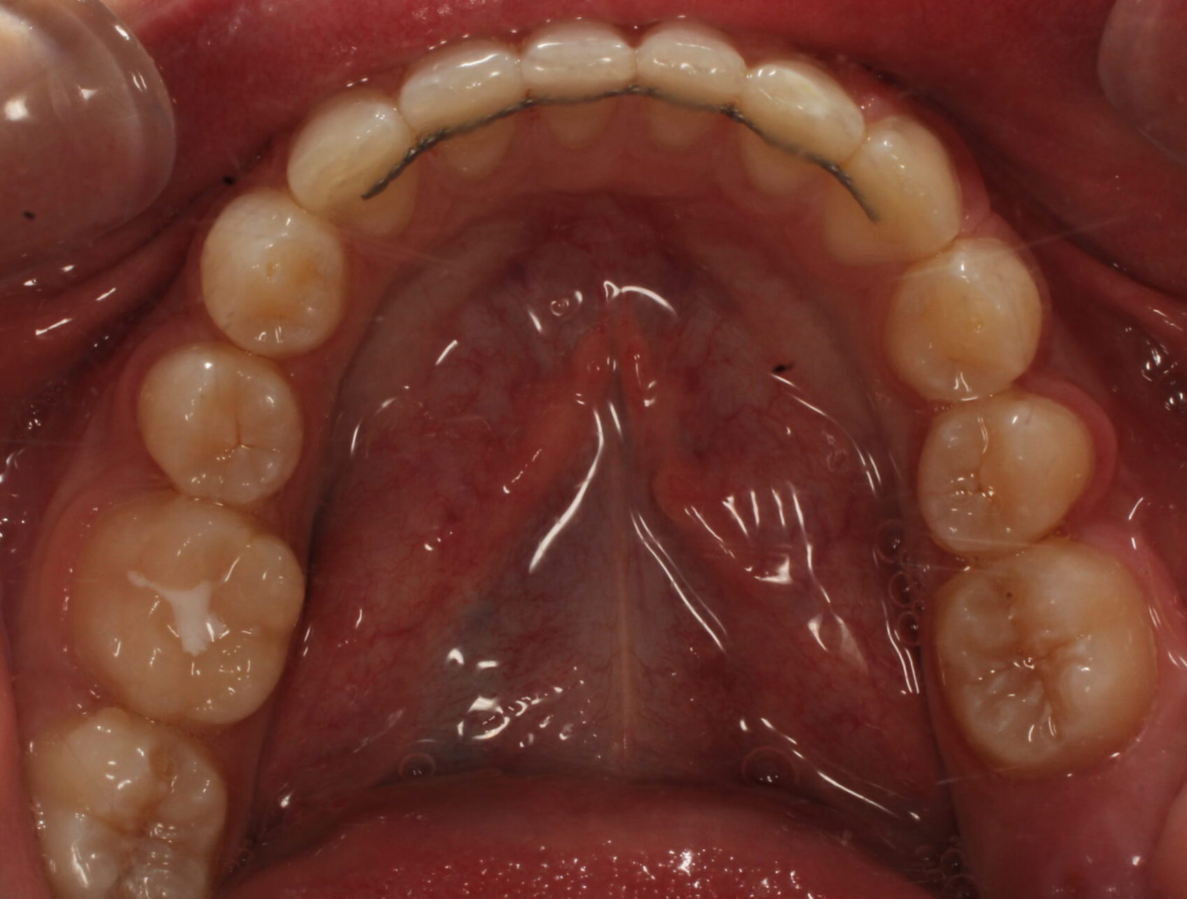 After braces lower teeth