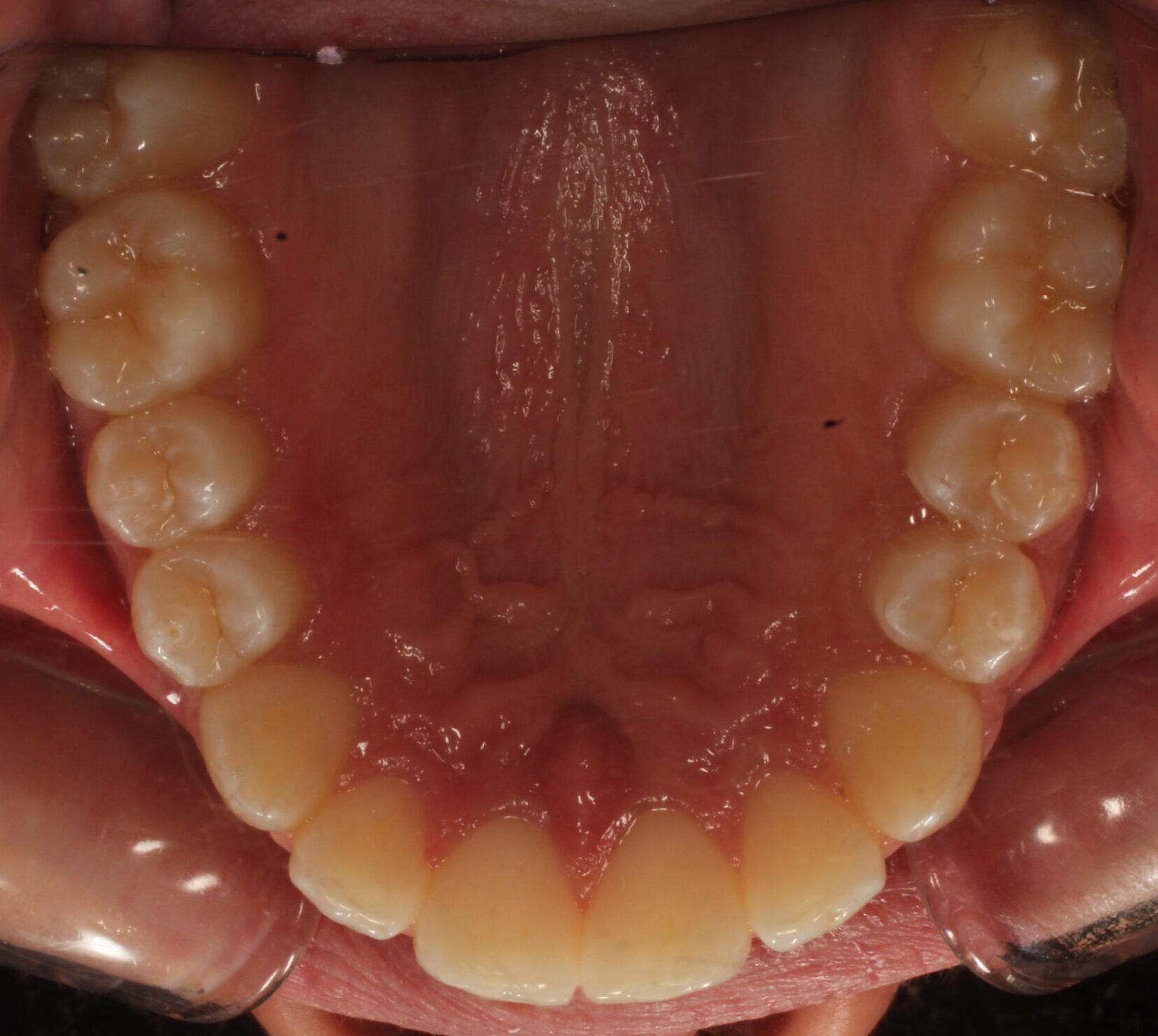 After braces upper teeth
