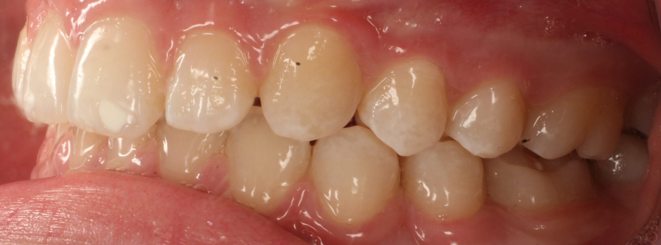 After braces left teeth