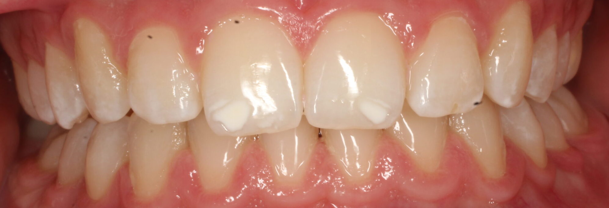 After braces front teeth
