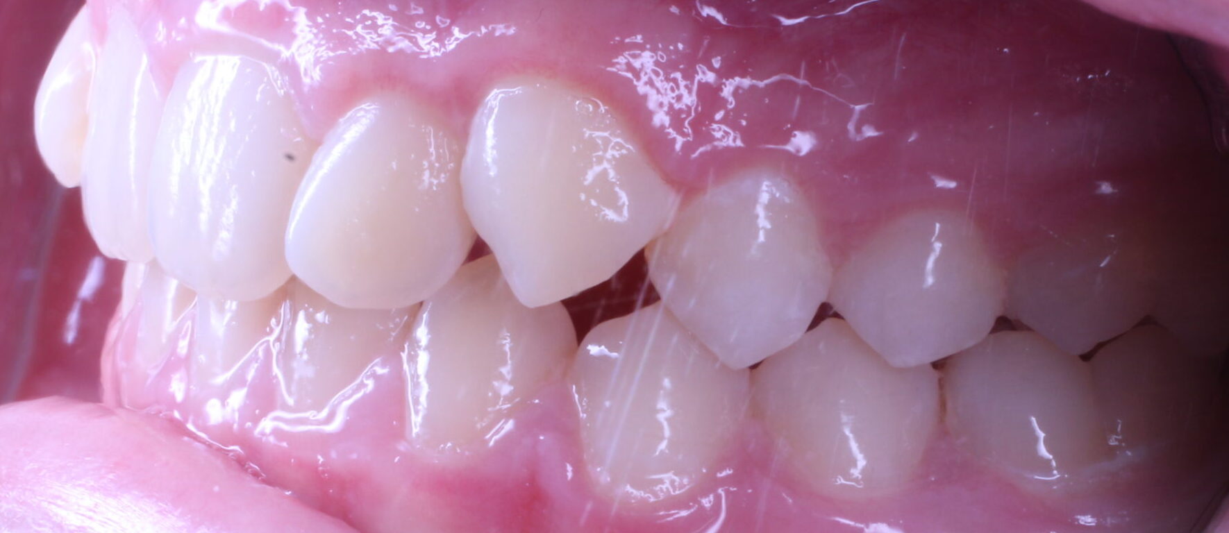 Before braces left teeth