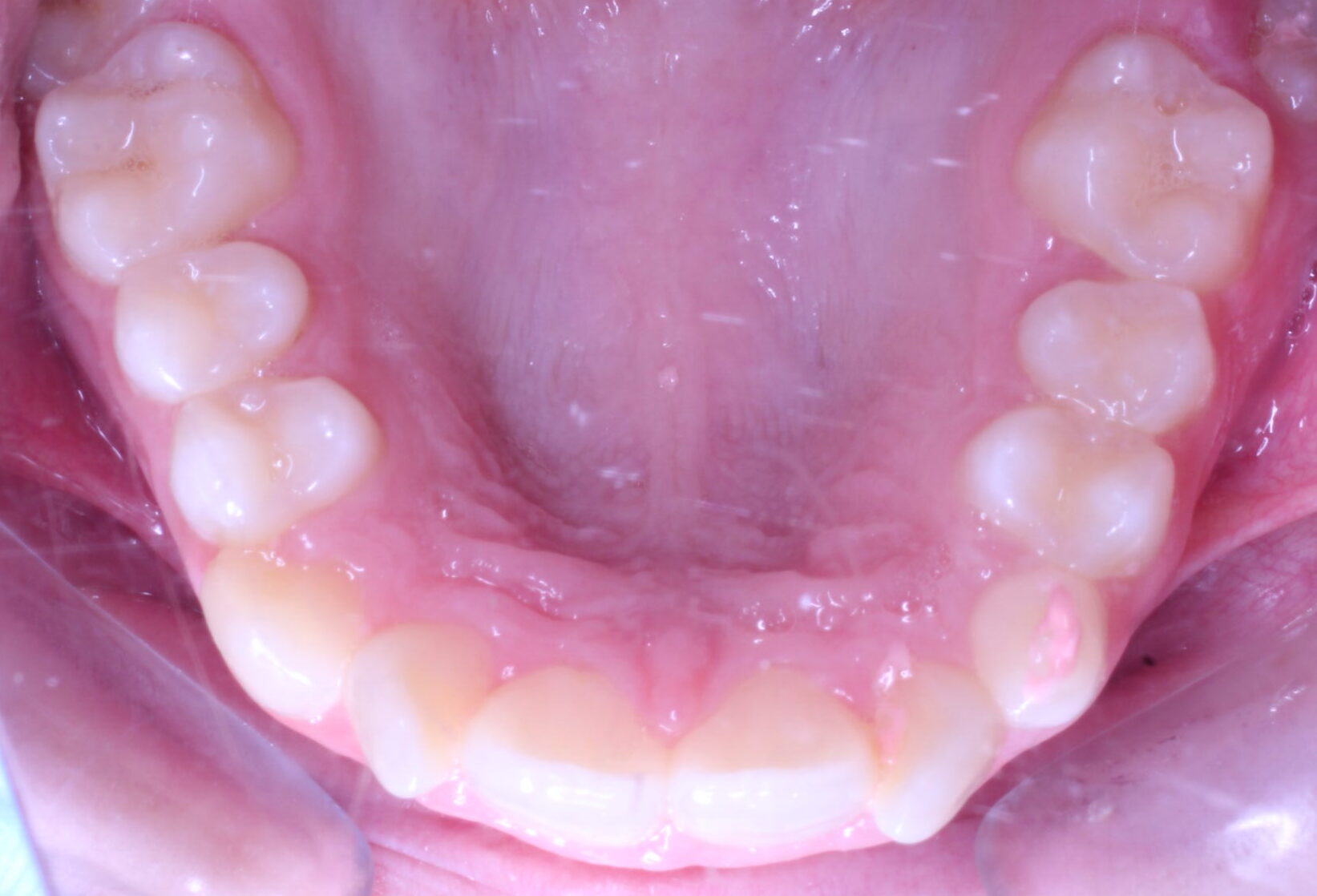 Before braces upper teeth